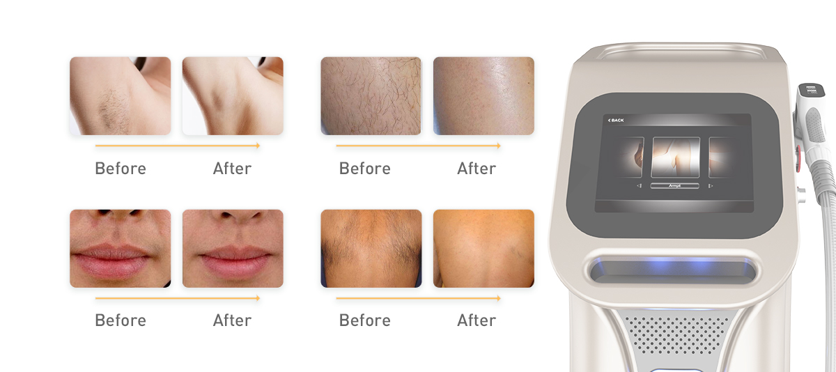 808nm Diode Laser Hair Removal of Suppliers