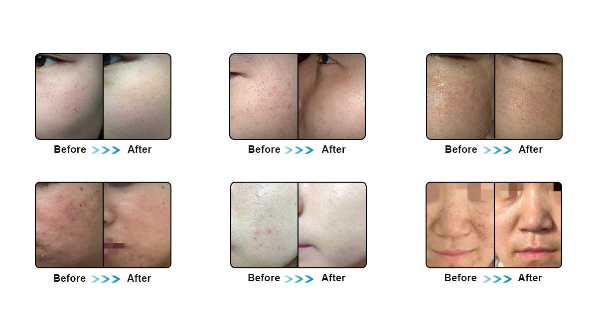 IPL Shr Hair Removal with Lowest Price of Company