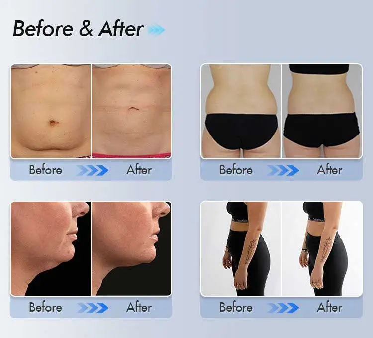 Vom Doppel kinn zum definierten Jawline: Cool Sculpting vor und nach