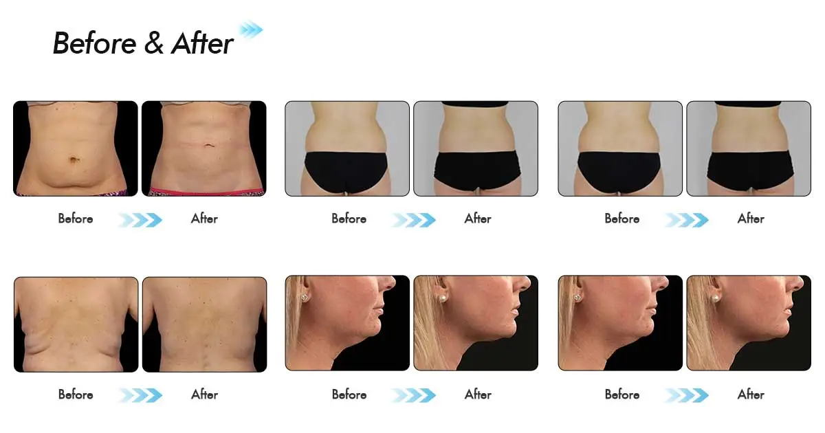 CoolSculpting-Effektivität: Visuelle Veränderungen nach 1, 2 und 3 Wochen