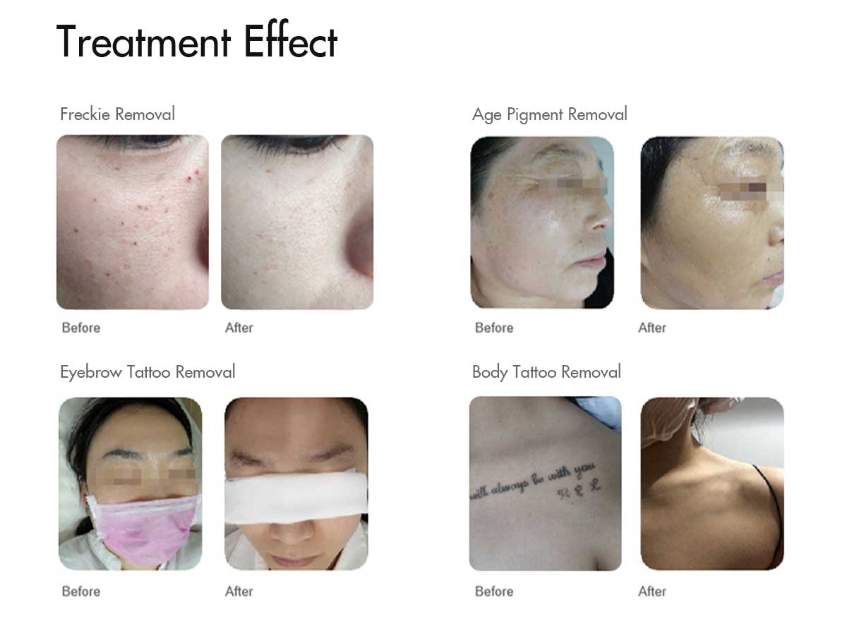 nd-yag-laser-before-and-after-dark-skin.jpg