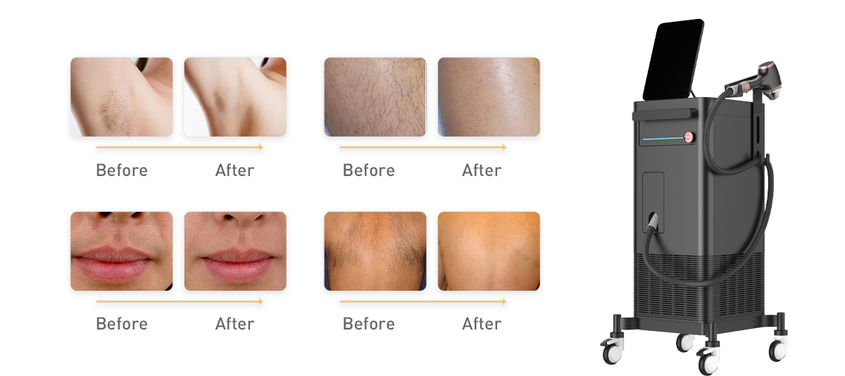 Welche Laser-Haaren tfernungs methode ist besser?