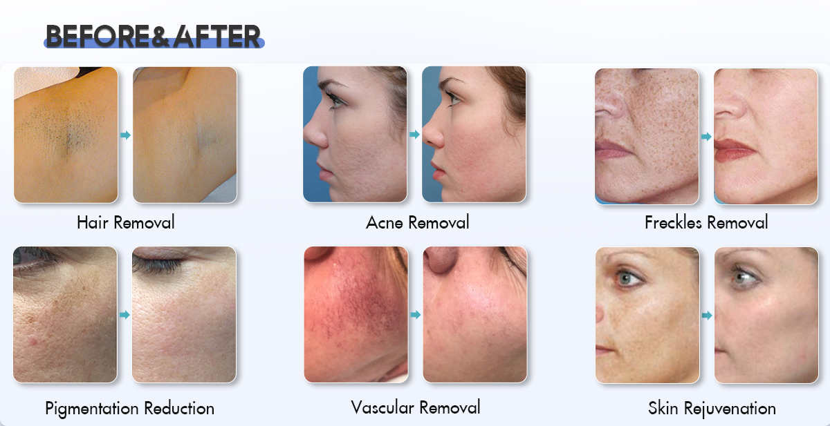 Opt_Shr_Ipl_Machine_For_Fast_Hair_Removal.jpg Opt_Shr_Ipl_Machine_For_Fast_Hair_Removal.jpg